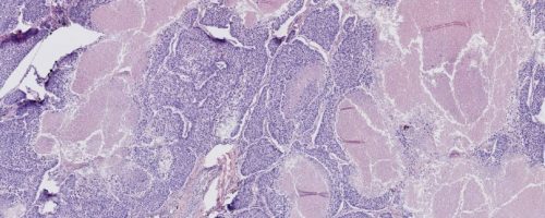 BioChain's CancerSeq™ Plus Paraffin Tissue Tumor Section: Lung